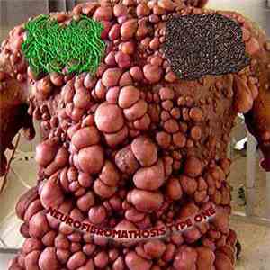 Urethrocuteneous Fistula Balanitis, Padagra - Neurofibromathosis Type One