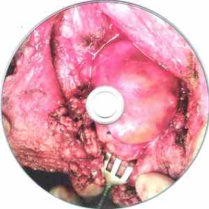Carcinosarcoma - Pathogenesis Beyond The Evil