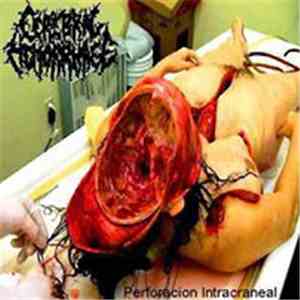 Cerebral Hemorrhage  - Perforacion Intracranea
