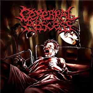 Cerebral Abscess - Cerebral Abscess