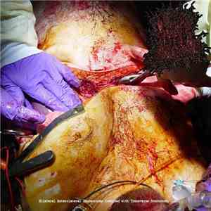 Vomiting Through An Infected Tracheotomy - Bilateral Anterolateral Thoracotomy Combined With Transverse Sternotomy