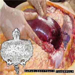 Urinary Tract Infection From Severe Pus Clots - Ompheleocytomic Tumorpulp